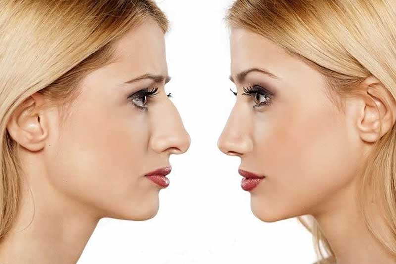 جراحی زیبایی بینی یا رینوپلاستی (Rhinoplasty)